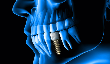 Dental Implant