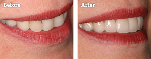 Patient before and after dental treatment at kcad