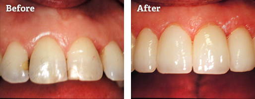 Patient before and after dental treatment at kcad